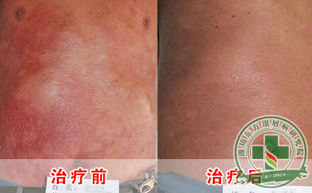 牛皮癣治可以保健