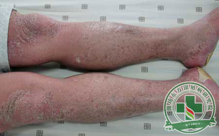 我们应重视银屑病的常见症状