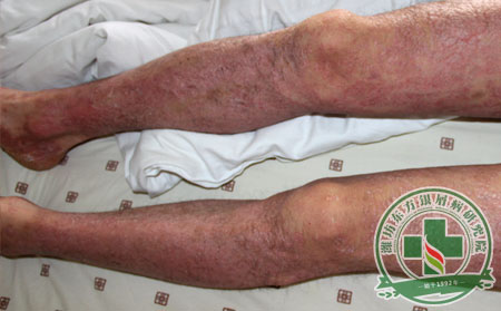 常见的三类银屑病治疗方法汇总