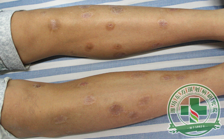 对待银屑病的症状采取哪些对应措施