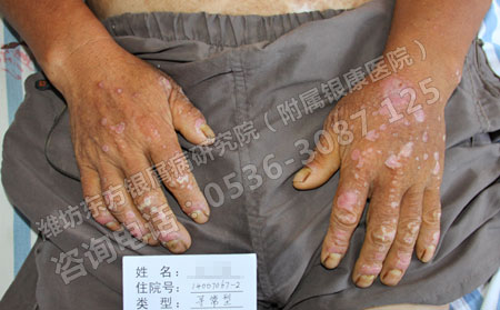 济南患者认可的银屑病医院