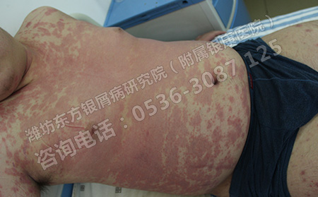 济南治疗牛皮癣哪家医院效果可以?