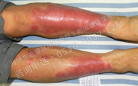 济南银屑病患者怎样选择可以的银屑病医院