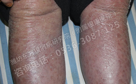 比较受推崇的牛皮癣护理措施介绍