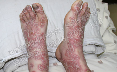 如何预防儿童牛皮癣的再次发生