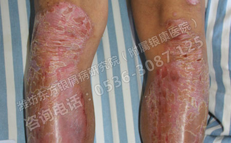 哪些食物有助于银屑病患者病情的改善