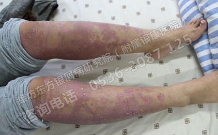 济南哪家医院治疗银屑病效果可以呢？