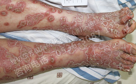 牛皮癣快速扩散的原因是什么