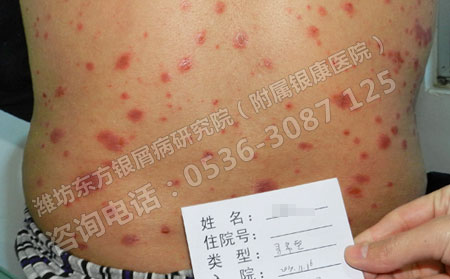 春季感冒诱发的银屑病前期有什么症状