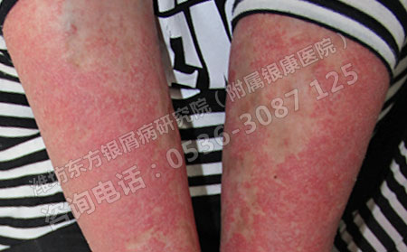 红皮型银屑病的治疗药物有哪些