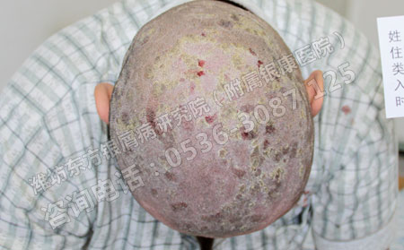 得了头部银屑病怎么办