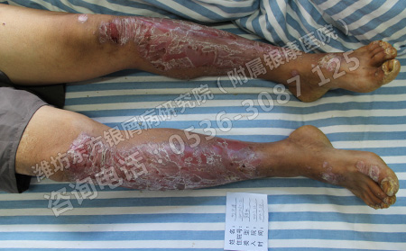 济南牛皮癣治疗需要花多少钱