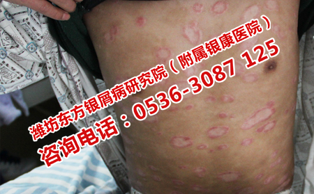 得了脓疱型牛皮癣吃点什么药有用