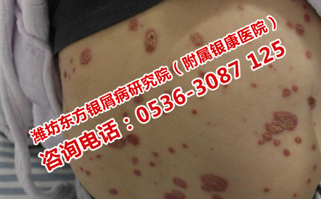济南中医治疗银屑病