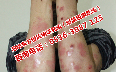 银屑病冬天的症状需要警惕