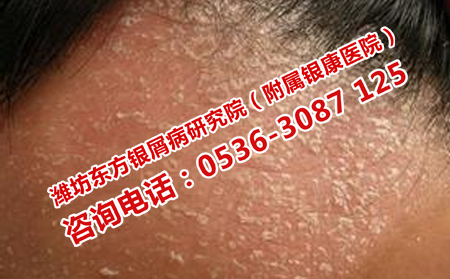 治头部牛皮癣的办法
