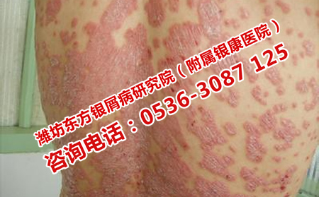 复方氨肽素治疗银屑病