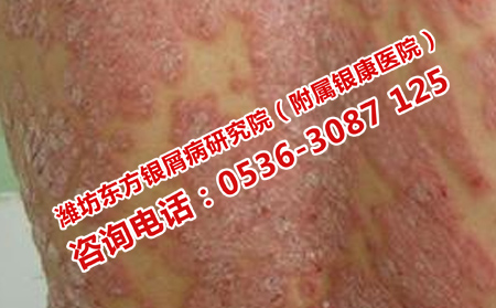 严重的银屑病还能治可以吗