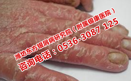 专门治疗银屑病的医院