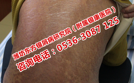 济南银屑病医院在哪里