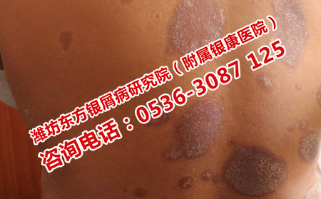 红皮型银屑病和寻常性银屑病的症状区分