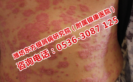 银屑病确诊的症状