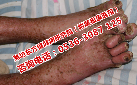 跑步能护理关节型银屑病吗
