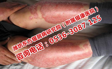 寻常型牛皮癣有哪些危害