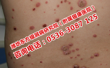 身上出现小红点的症状是银屑病吗