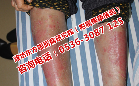 济南银屑病护理