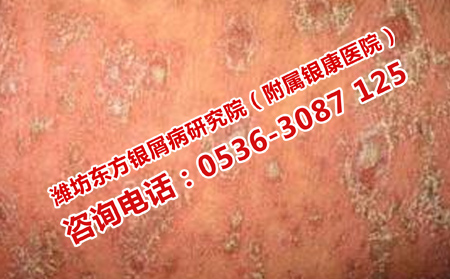 济南中医治牛皮癣