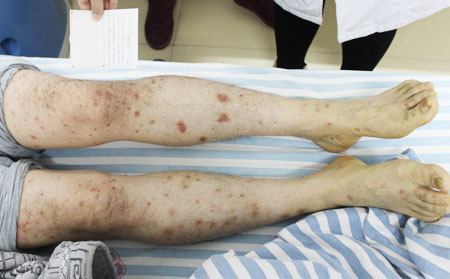 小孩银屑病如何治疗