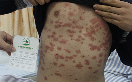 什么症状的银屑病需要住院治疗