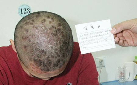 预防银屑病遗传的方法