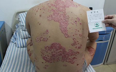 治疗银屑病的时候如何去除诱因