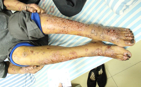 济南银屑病医院治疗