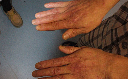 济南哪里治银屑病可以