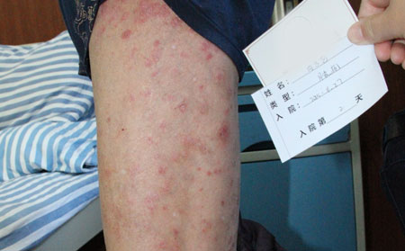 如何预防银屑病复发呢