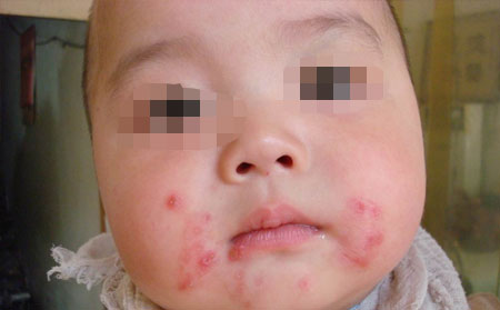 牛皮癣的判定方法