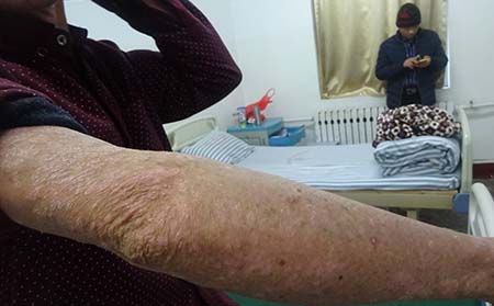 银屑病治疗误区介绍