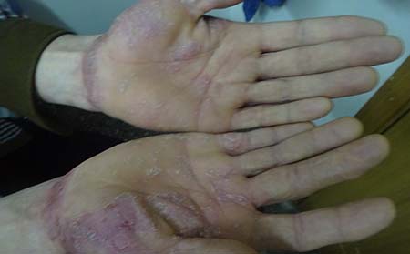 银屑病的三个治疗误区