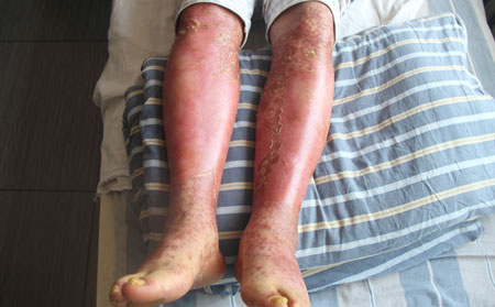 银屑病常识知识